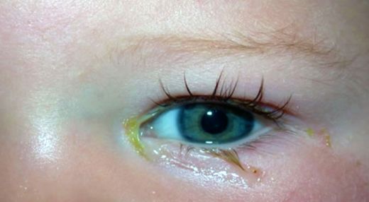Bebeklerde Göz Çapaklanması Nasıl Geçer